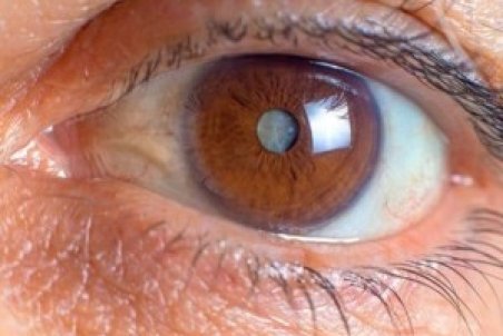 آب مروارید چیست و چه علائمی دارد؟