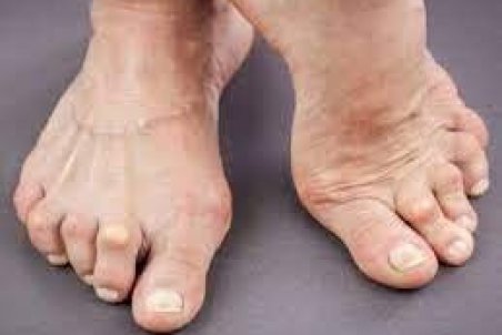 بیماران مبتلا به "نقرس" این نکات تغذیه‌ای را رعایت کنند