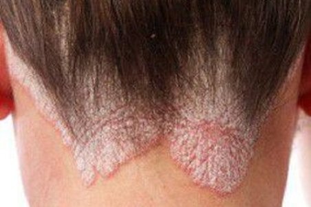 عامل بیماری پسوریازیس پروتئین‌ است