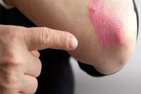 علائم پسوریازیس (صدف) ، شایع ترین بیماری پوستی