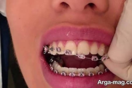 آشنایی با خطرات و عوارض ارتودنسی