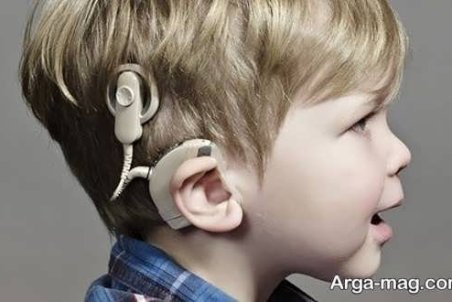 آشنایی با عمل کاشت حلزون گوش