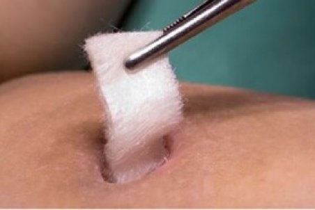 درمان زخم‌های عمیق با پانسمان‌های پودر