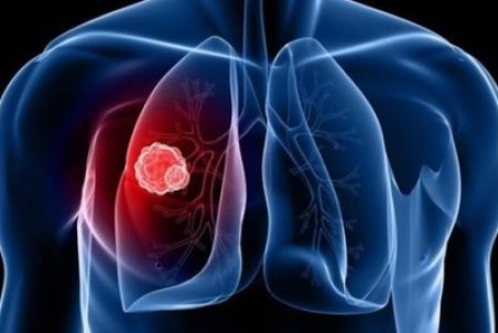 علائم رایج سرطان ریه چیست؟