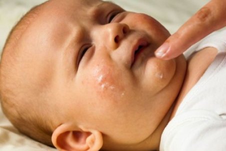 روش‌های درمان خشکی پوست در کودکان + فیلم