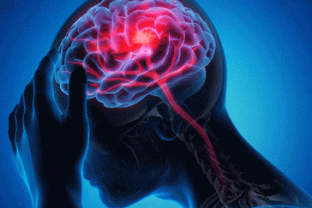 علائم زنگ خطر سکته مغزی + فیلم