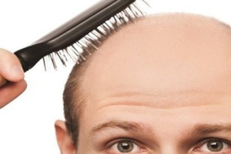 درمان خانگی ریزش مو با ۴ روغن