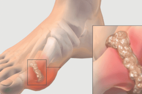 توصیه‌ های غذایی به مبتلایان به نقرس + فیلم