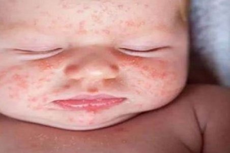 عارضه مخملک را جدی بگیرید!