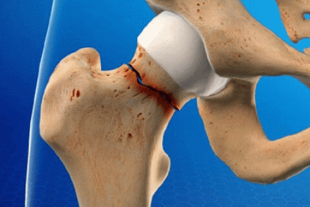 چه کسانی باید سنجش تراکم استخوان را انجام دهند؟ + فیلم