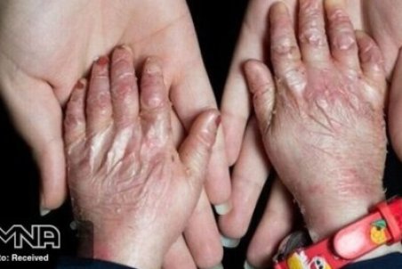 زخم‌های بدون التیام