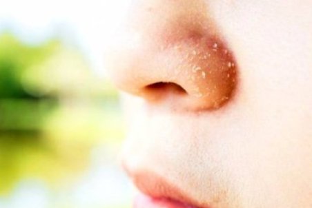 از علل تا راه حل خشکی پوست بینی و پوسته پوسته شدن دور آن