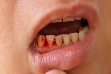علت خونریزی لثه و نحوه جلوگیری از آن