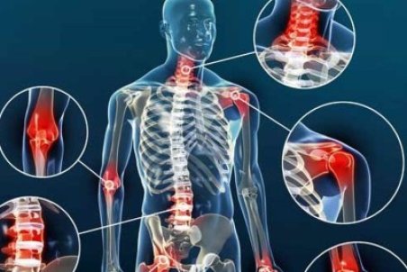 علائم آرتروز و راه‌های پیشگیری و درمان