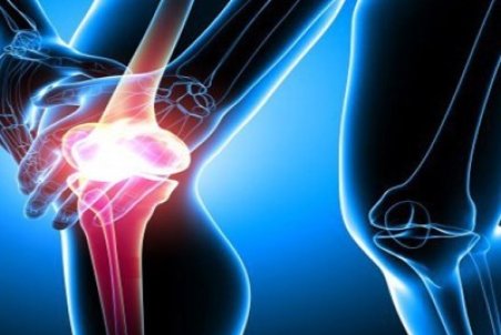 درمان گیاهی آرتروز