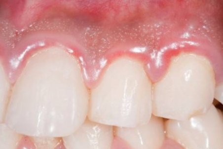 چرا لثه ورم می کند ؟ علت تورم لثه چیست؟