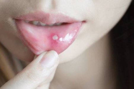 علائم آفت دهانی + درمان