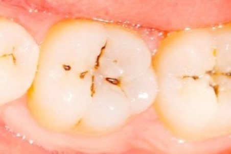 پوسیدگی دندان شایع‌ترین بیماری دهان است