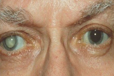 آب مروارید چگونه ایجاد و درمان می‌شود؟