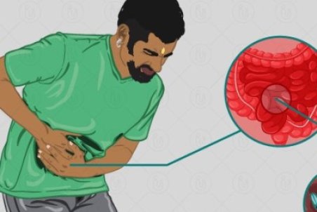 همه چیز درباره بیماری آمیبیاز از علایم تا روش های درمان