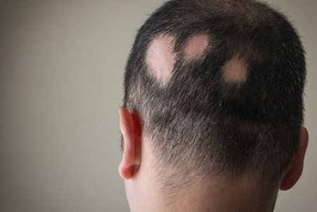 با انواع بیماری مو آشنا شوید و برای درمان آن اقدام کنید!