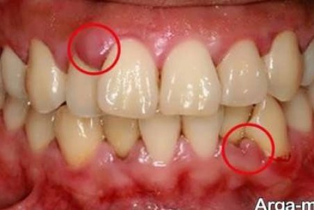 علت عفونت و آبسه دندان در دوران بارداری