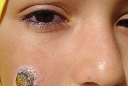 انتقال محلی سالک در ۱۸ استان کشور؛ بیش از ۱۰۵۰۰ ابتلا در سال جاری