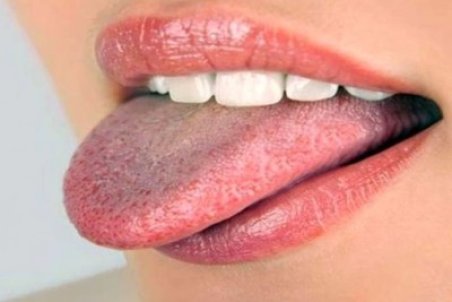 روش‌های خانگی برای درمان «برفک دهان»