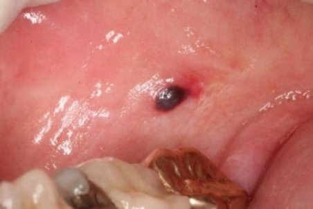 علل و راههای درمان تاول های خونی در دهان