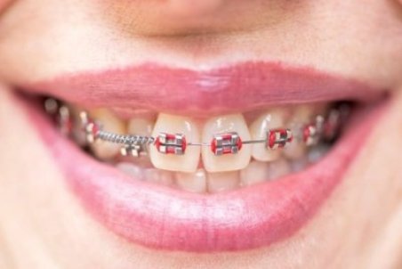 انواع عوارض ارتودنسی را بشناسید