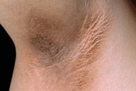 درمان تیرگی زیر بغل در طب سنتی