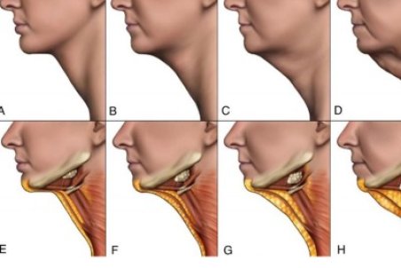 چگونگی لیفت گردن بدون جراحی