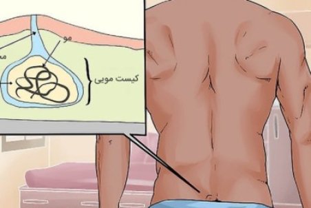 کیست مویی چیست؟ + علائم  و درمان