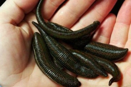 با زالو چه بیماری‌هایی درمان می‌شود؟