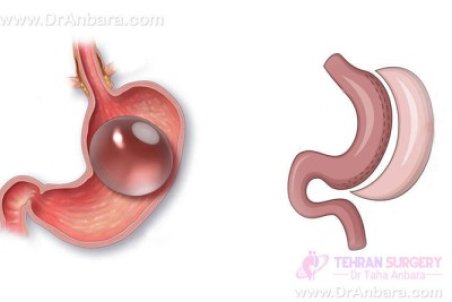 بالون معده چیست و با چه عوارضی همراه است؟