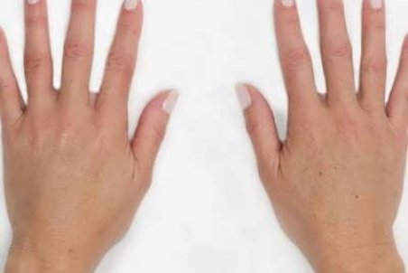 تزریق چربی به دست چیست؟ + مزایا و معایب