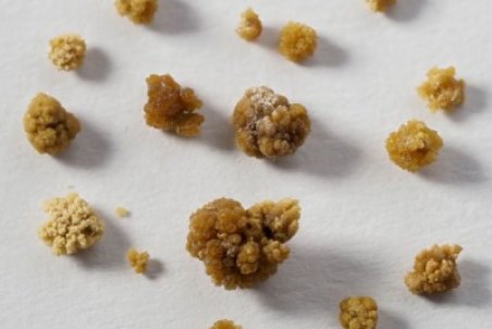 برای دفع سنگ کلیه چه بخوریم؟