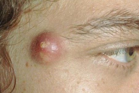 علل ، تشخیص و درمان کیست سباسه