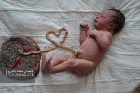 زایمان لوتوس یا نیلوفر آبی چیست؟ + فواید و خطرات