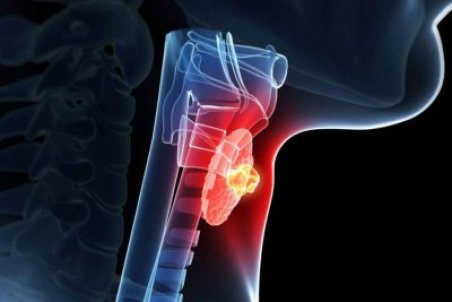 علائم و راه های درمان بیماری کم کاری تیروئید + فیلم