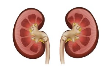 باید و نبایدهای تغذیه ای در بیماری سنگ کلیه + فیلم