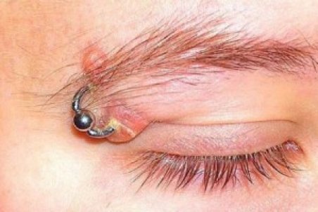 پیرسینگ پارتی؛ متهم ردیف اول هپاتیت