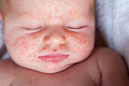 علائم بروز گال در کودکان + روش درمان